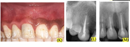 Kishen lab collaborated to treat maxillary anterior teeth with extensive root resorption using light-activated engineered nanoparticles